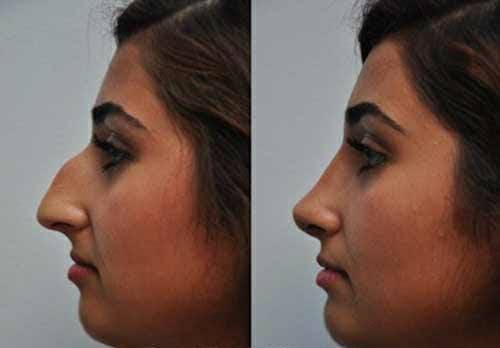 photo avant apres rhinoplastie en tunisie