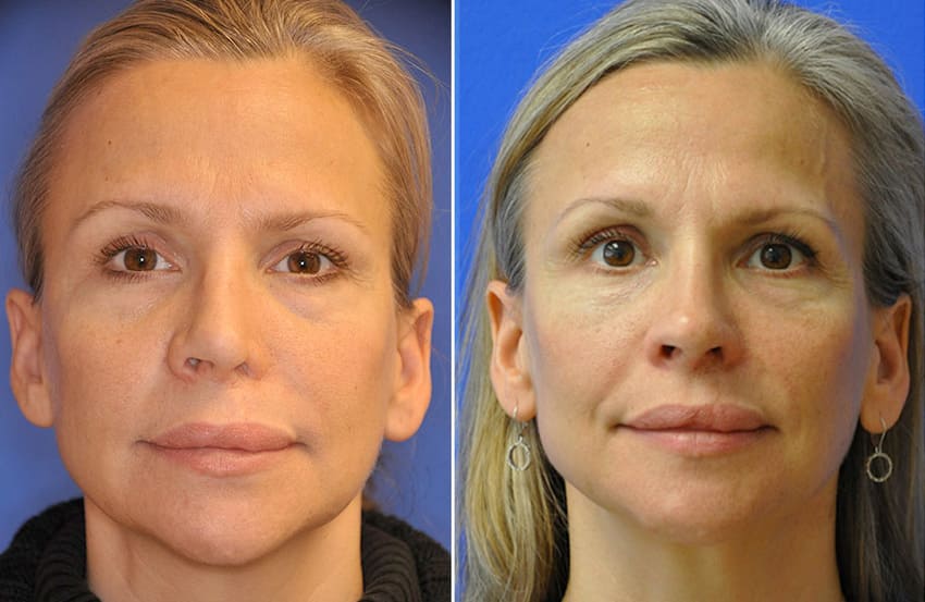 Photo avant après d'une rhinoplastie secondaire en Turquie