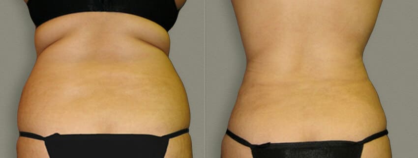 Photo avant et après d'une Mommy Makeover de dos en Turquie