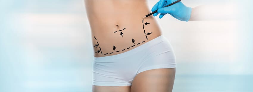 Tracés du chirurgien avant une chirurgie post-accouchement