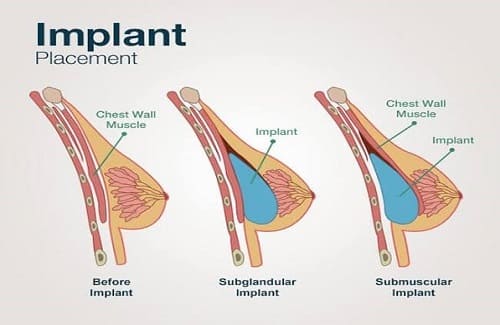 Meme implantlarının kas altına ve üstüne implantasyon şeması