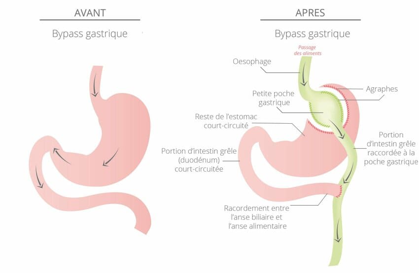 Schéma avant et après d'un bypass gastrique