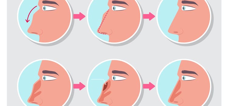 rhinoplasty diagram