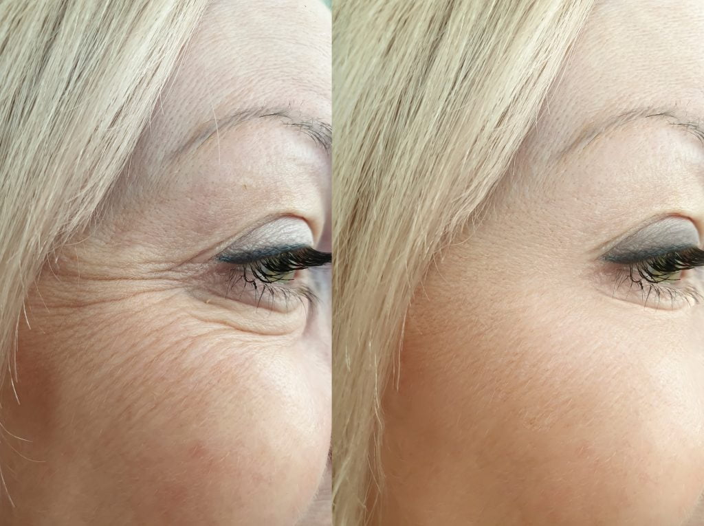 Blépharoplastie en Tunisie : Photo avant après