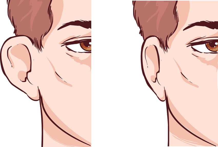 Illustration sur l'otoplastie