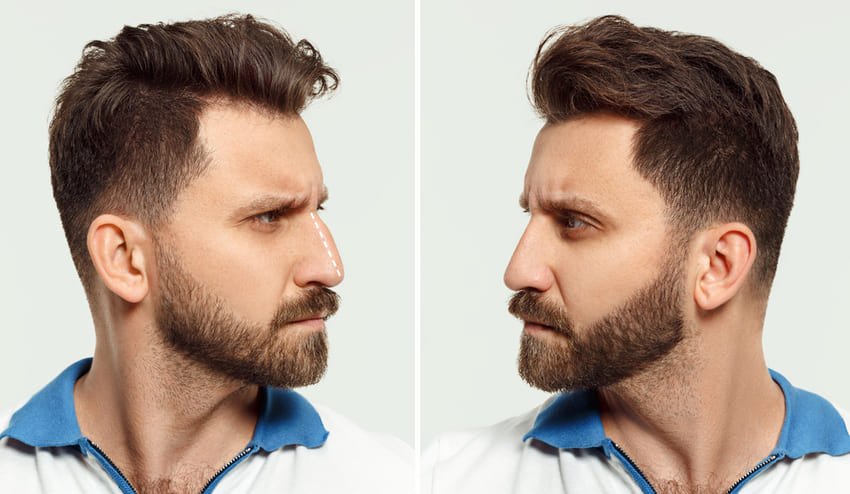 Rinoplasti sonrası bir erkek fotoğrafı