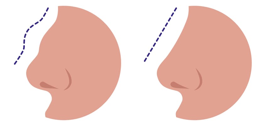 Burun üzerindeki tümseği çıkarın
