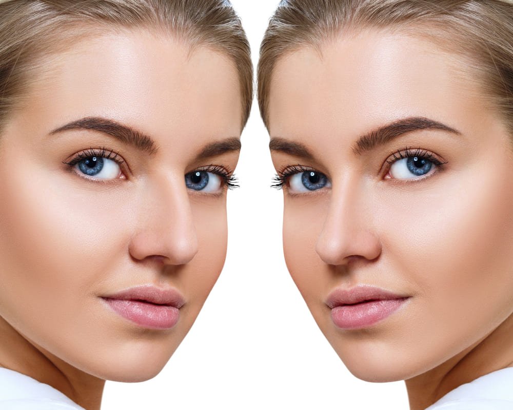 Rinoplasti öncesi ve sonrası simülasyon