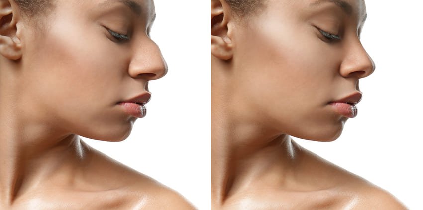 Simulation avant et après une rhinoplastie ethnique