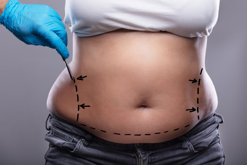 Ventre d'une femme marqué de ligne pour un mommy makeover